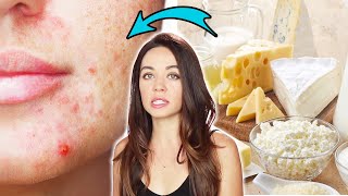 Nutritionists Reveal Which Foods Affect Your Acne