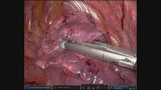 Robotic Right Apical Segmentectomy (S1)