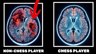 What Chess Does to the Brain Is Not Normal.