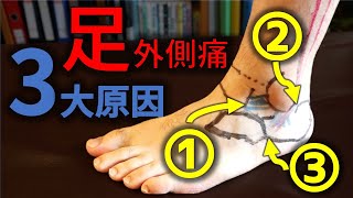 【足外側が痛い】3大原因とは！？一目で分かるように可視化してみた