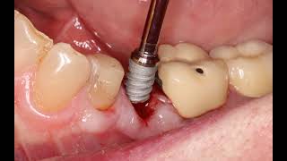 Atraumatic Extraction \u0026 Placement of OsteoGen® Bone Grafting Plug: Immediate Implant Placement