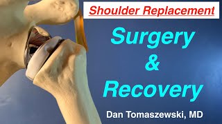Shoulder Replacement, surgery and recovery