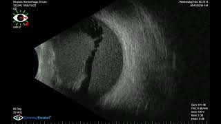 Vitreous Hemorrhage B Scan. VuPad - Ophthalmic Ultrasound by Sonomed Escalon