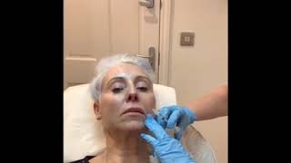 Belotero Lip filler treatment