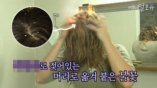 머릿니를 없애려 했던 이 행동 때문에 사고가 났다?! | KBS 위기탈출 넘버원 090601 방송