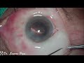 TIPS AND TRICK TO TACKLE CHEMOSIS DURING CATARACT SURGERY - Dr.  Saurav Piya