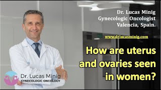 ✅ How are uterus and ovaries seen in women? Dr Lucas Minig. Gynecologic Oncologist. Valencia, Spain