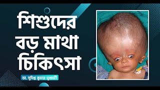 শিশুদের অতিরিক্ত বড় মাথা বা হাইড্রোসেফালাস এর চিকিৎসা | Hydrocephalus Baby Treatment