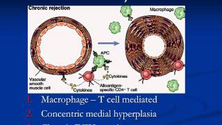 Heart transplantation