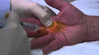 Percutaneous Trigger Finger Release : Donald Ditmars MD, FACS