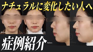 【鼻整形】”ナチュラルに変化したい人向け”の手術メニュー解説。手術を受けた患者様の症例を紹介！ビフォーアフターやダウンタイムまで【鼻尖形成/軟骨移植】