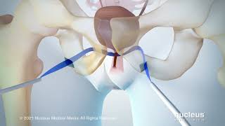 Urinary Incontinence: Transobturator Tape (TOT) Procedure