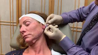 Non-Invasive Facelift with MINT