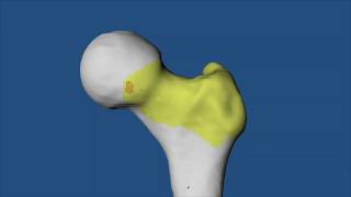 Simulation of Surgery and ROM   Live Surgery Case HSB 2020