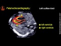 Fetal echocardiography at 11-13 weeks: Technique of Early Heart Scan