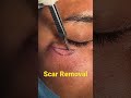 scar removal by plastic surgery