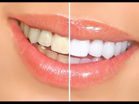 DIY- Whiten Your Teeth Naturally (Coconut Oil) DIY- Whiten Your Teeth Naturally (Coconut Oil)