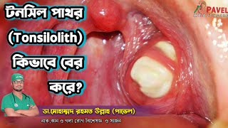 টনসিল পাথর (Tonsilolith) হলে কি করবেন ❓