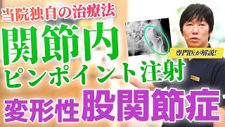 【変形性股関節症に効果的な再生医療】末期症状でも手術無しで完治！ピンポイント注射が鍵！痛みも緩和され歩き方も正常に【医師が解説】