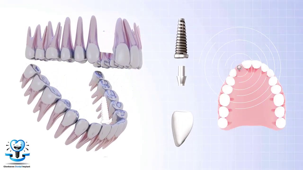 Dental Implant Procedure - YouTube