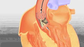 CoreValve Animation FINAL 2 24 14