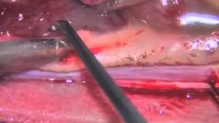 Laser-assisted microsurgical resection of thoracic intramedullary spinal cord ependymoma