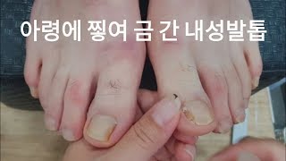 [시원함주의!!] 아령에 찧인 내성 발톱!!😱왕건이 시원하게 뽑아내기!!😆(ingrown nail/Athlete's nail)