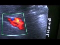 NON OBSTRUCTIVE CLOT in the PORTAL VEIN