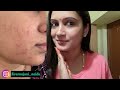 7 days challenge remove pimple marks u0026 acne scars naturally at home మొటిమలు మచ్చలు తగ్గాలంటే