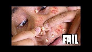 Best Satisfying Pimple Popping Compilation 2019 - Viewire