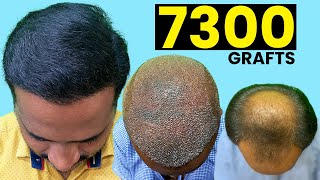 Grade 6 Baldness - 7300 Grafts Hair Transplant | Best Hair Transplant In India |