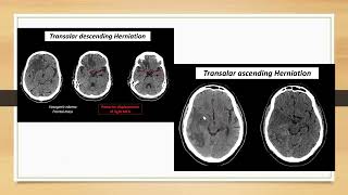 Brain herniation