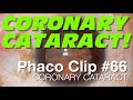 Phaco Clip #66 - Coronary Cataract