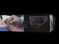 VenaCure Pvak : perforator and accessory vein ablation kit - Société Française de Phlébologie