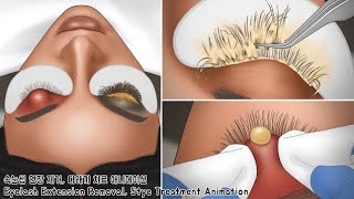 ASMR 뭉치고 오래된 속눈썹 연장 제거 \u0026 왕 다래끼 치료 애니메이션 | Lash Deep Cleaning \u0026 Stye Treatment Animation