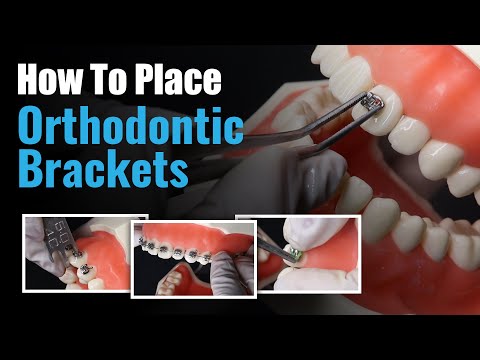 How to place orthodontic brackets Waldent Metal Bracket Kit MBT 022 Slot