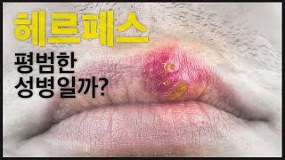 헤르페스의 정의와 관리방법은? | 기전, 효과, 주의사항, 부작용