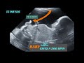 13 weeks | Baby boy | does 360 spin in womb | Ultrasound