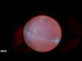 repairing a toxoplasmosis related retinal detachment with external needle drainage