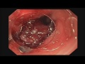 management of post operative duodenal fistula using ovesco otsc system