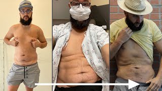 Male Liposuction and Chest Reduction | Michael's Gynecomastia and Fat Loss Review with Sono Bello