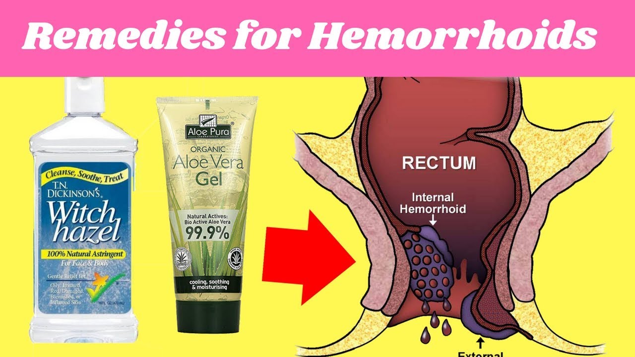 4 Home Remedies For Hemorrhoids | Hemorrhoid No More - YouTube