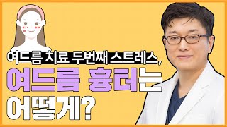 광주레이저토닝 여드름으로 스트레스 받고 있다면!