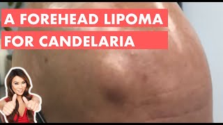 A Forehead Lipoma for Candelaria