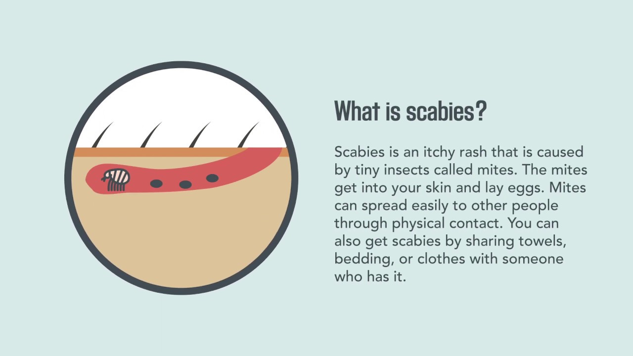 Scabies: Signs, Symptoms, Causes, And Treatment | Merck Manual Consumer ...