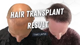 Hair Transplant 5000 Grafts Before and After | Hair Transplant  Time Lapse | Hair Transplant Result