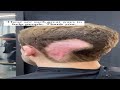 Hair Patch Magic | Bald No More | Lavivid Hair System