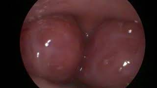 hypertrophie obstructive des amygdales - obstructive tonsillar hypertrophy