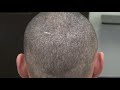 fue scar after two fue hair transplant restoration surgery by dr. diep http www.mhtaclinic.com