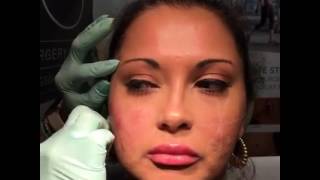 Voluma Juvederm Lip Filler Demonstration 3